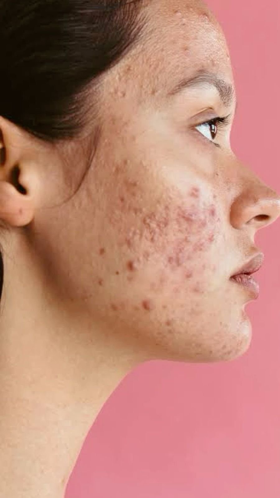 Acne